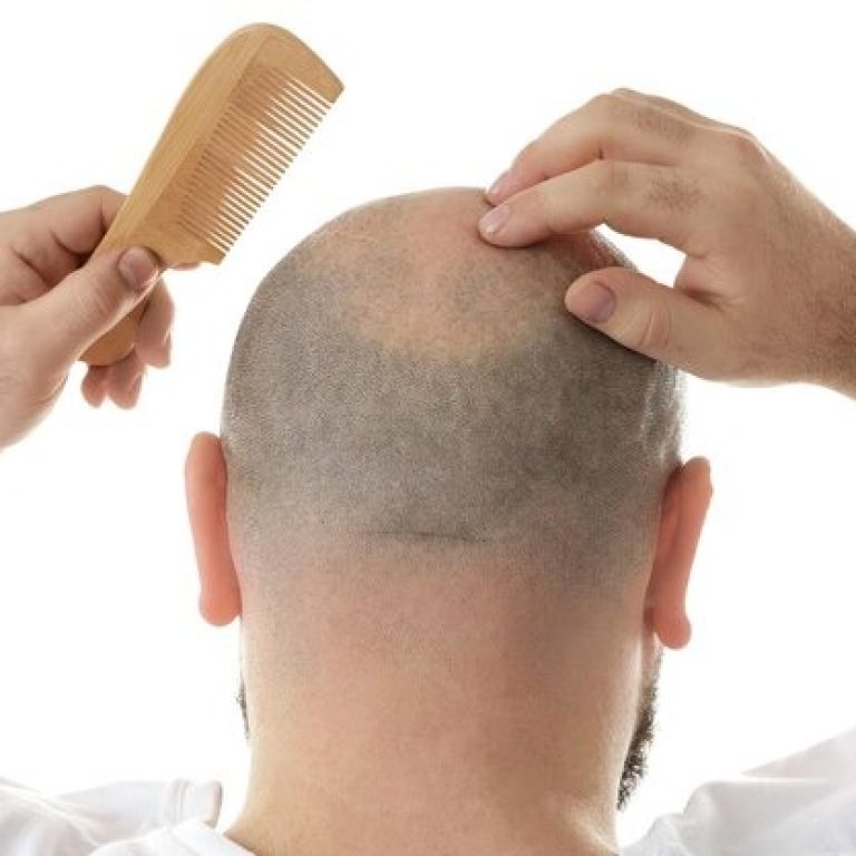 Vertex Hair Transplantation Turkey